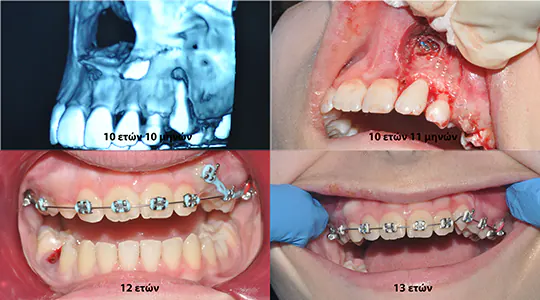 second dental case